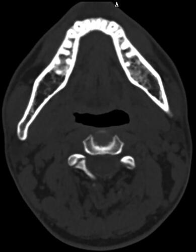 Figure 2. One example of face asymmetry by CT scanning.