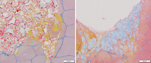 FIGURE 5. Representative histologic samples for (A) SmGM and (B) PCCT, depicting the bottom corner of the defect. Samples are stained for fibrin (red), fresh fibrin (yellow), erythrocytes (yellow), connective tissue (blue), and collagen (blue).