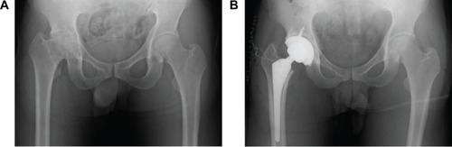 Figure 1 Anteroposterior hip radiographs of case 1 (31-year-old male with severe hemophilia).