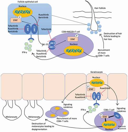 Figure 1. Mechanism of action for JAK inhibitors in Alopecia Areata (above) and Vitiligo (below). The pathogenesis of vitiligo begins with the activation of JAK ½ in a keratinocyte via binding of IFN-γ secreted by CD8+T cell. The dimerization of JAK1/2 via autophosphorylation activates the STAT protein which, in turn, leads to the production of proinflammatory cytokines. Subsequently, these cytokines lead to the activation and recruitment of more CD8+T cells via JAK 1/3 which target local melanocytes. Similarly, the pathogenesis of alopecia areata involves the activation of a CD8+T cell which causes the secretion of IFN-γ and, subsequently, activates JAK1,2,3 via signaling cascade. This results in the inflammation and destruction of a hair follicle.