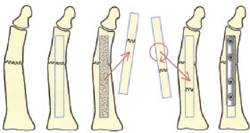 Figure 1. Schematic representation of turnaround inlay graft for MTP 1 pseudarthrosis.