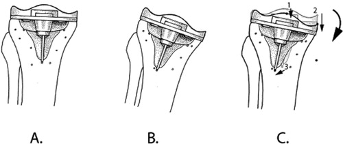 Figure 5. The position and orientation of the tibia and the tibial component are defined in the reference RSA radiograph at t1 (A.). In an RSA radiograph made at t2, the position and orientation of the tibia will not be exactly the same as at t1 (B.). In order to assess the micromotion of the implant between t1 and t2, the bone markers must be matched onto each other, and the micromotion—in this case, rotation—of the implant can be assessed (indicated by the curved arrow). In some studies, only translations of single points of a rigid body are presented. One should be cautious in using this approach: the translation of point 2 is greater than the translation of point 1 (points indicated by black dots; translations indicated by straight arrows). The direction of the translation of point 3 is completely different from the translations of points 1 and 2. Thus, the same points of measurement should be used in all patients.