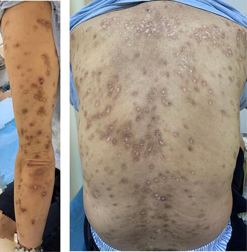 Figure 4 W16 (prurigo nodularis improved after acupuncture therapy at week 16).