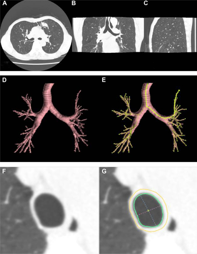 Figure S1 (A–C) Original CT images. (D) An example of airway lumen segmentation. (E) An example of centerline tree construction. (F) The original crosscut image.(G) An example of wall contour estimation (green indicates the inner wall contour, yellow indicates the outer wall contour, blue dotted line indicates the maximum diameter, and pink dotted line indicates the minimum diameter).