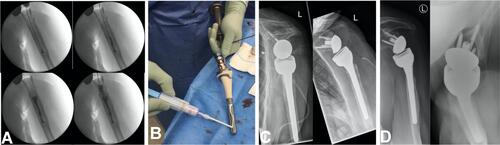 Figure 4 Implant coating of a shoulder prosthesis; (A) Filling the medullary canal with 19 ml Cerament V; (B) coating of the prosthesis with Cerament V; (C) x-ray 2 moths after implant coating; (D) x-ray 15 moths after implant coating.