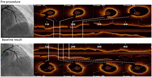 Figure 1. Selected optical coherence tomographic cross sections of coronary artery lumen matching the centerline of coronary angiography.