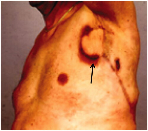 Figure 3. The fistula recurred (arrow) despite the transferred LD-flap.