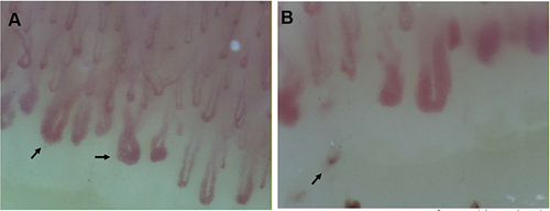 Figure 1 (A and B) demonstrate nailfold video-capillaroscopy findings in a patient with very early SSc who presented with RP and anticentromere antibodies. Arrows in (A) identify giant capillaries. (B) demonstrates capillary drop-out; the arrow in this panel identifies a microhemorrhage.