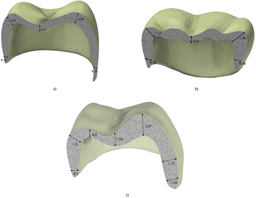 Figure 1. Thickness of the crown a) thin b) typical thickness crown.