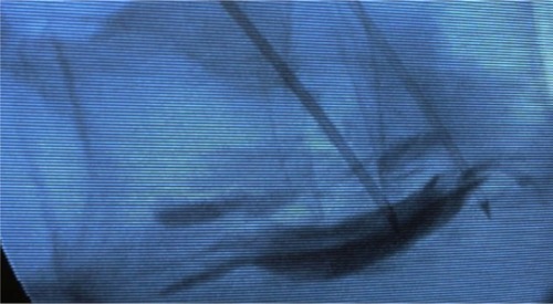 Figure 1 Fluoroscopic view of the spine in lateral position at the level of L1 with the insertion tubes in each side of the prevertebral space.