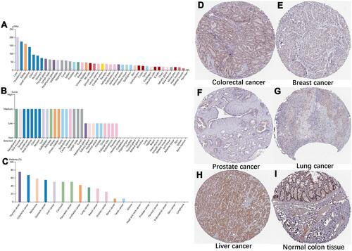 Figure 2 Expression of SEPHS2 in tumor tissues and normal adjacent tissues. (A) SEPHS2 mRNA expression derived from various normal tissues. (B) Expression levels of SEPHS2 protein in different human normal tissues. (C) Expression of SEPHS2 protein in tumor tissues from 20 types of cancers. (D–I) Immunohistochemical images of SEPHS2 protein expression in colorectal cancer, breast cancer, prostate cancer, lung cancer, and liver cancer tissues, and normal colon tissue.