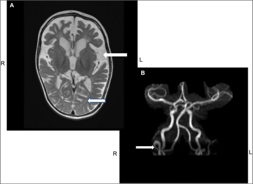 Figure 4 MRI of the brain (A) and MRA (B) from the same patient.