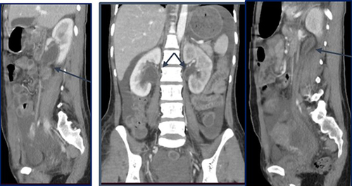 Figure 4 CECT; Sagittal (right and left) and coronal (middle) recon images showing the bilateral renal sinus, PUJ and proximal ureteric wall thickening (long arrows, angled short arrows).