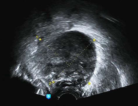 Figure 2 Grayscale ultrasound image showing a well-defined mass in the posterior vaginal wall (2020.05.25).