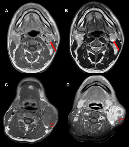 Figure 1 Representative MRI results illustrating the cervical nodal necrosis (CNN) and extranodal extension (ENE) in two patients with NPC. (A) Axial T1WI and (B) Axial T2WI in a 41-year-old man with CNN (arrows); (C) Axial T1WI and (D) contrast-enhanced T1WI in a 45-year-old man with ENE infiltrating the adjacent muscle (stars).