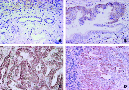 Figure 1.  Immunohistochemical staining patterns of MetAP2 in human bile duct epithelium. A: normal biliary cells with negative staining, 40×magnification; B: hyperplastic and dysplastic bile duct epithelia with moderate staining, 20×magnification; C: well differentiated tubular CCA, 20×magnification and D: lymph node with metastatic CCA, with strongly positive staining, 10×magnification.