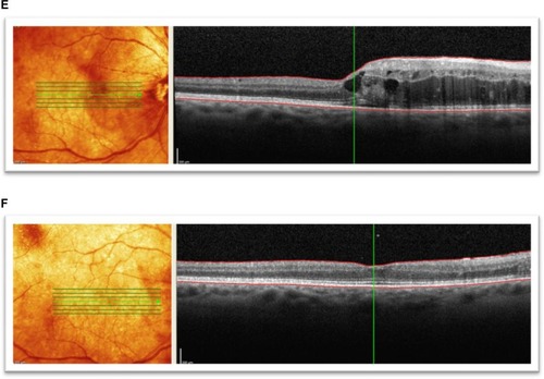 Figure 3 Spectral domain optical coherence tomographic images of three patients showing improvement in best corrected visual acuity to 20/50 or better following bevacizumab treatments for radiation maculopathy. (A) Patient 1: underwent plaque brachytherapy (right eye) with 20/25 vision at the time. Four years after treatment, the patient presented with subretinal fluid and foveal cysts, grade 6 with best corrected visual acuity of 20/80, and mean foveal thickness of 802 μm. (B) Patient 1: after treatment with six intravitreal bevacizumab treatments over 19 months, visual acuity improved to 20/25 and macular edema improved to grade 4. Mean foveal thickness decreased to 339 μm. (C) Patient 2: underwent plaque brachytherapy (left eye) with 20/400 vision at the time. Twenty-two months after treatment with plaque brachytherapy, the patient presented with grade 5 macular edema and best corrected visual acuity of 20/70 with mean foveal thickness of 483 μm. (D) Patient 2: after treatment with five intravitreal antivascular endothelial growth factor injections over 12 months, visual acuity improved to 20/25, macular edema improved to grade 4, and mean foveal thickness decreased to 366 μm. (E) Patient 3: presented with radiation maculopathy (grade 6) 31 months after treatment with plaque brachytherapy with 20/30 in the right eye and mean foveal thickness of 472 μm. (F) Patient 3: after receiving two intravitreal antivascular endothelial growth factor injections over 10 months, vision improved to 20/30, macular edema grade resolved to normal from grade 6, and mean foveal thickness decreased to 284 μm.
