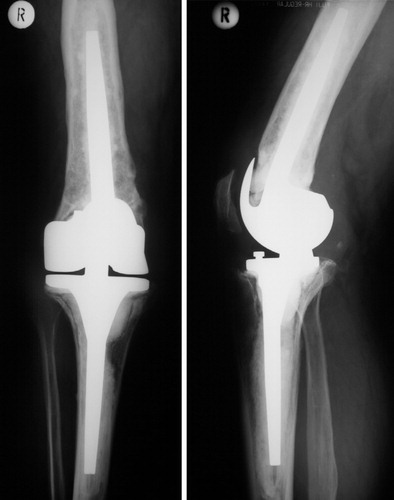 Figure 3. Postoperative control after IBG reconstruction of the femoral cavity in patient A, who had a type-3 defect.