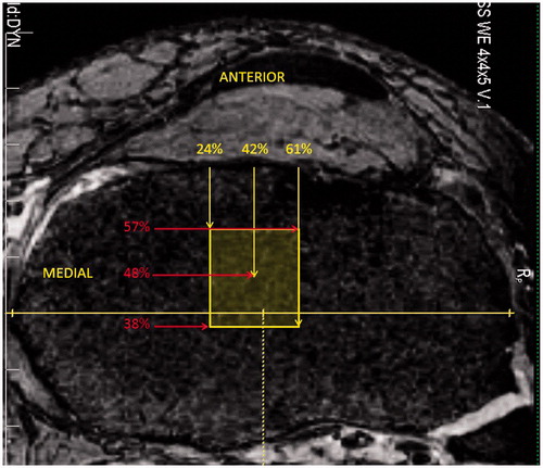Figure 1. Mean preoperative tibial ACL footprint as determined using sagittal and coronal MRI with overlay on an axial image. The maximum sagittal and coronal widths of the tibia were determined, and the anterior, posterior, medial and lateral extents of the ACL were measured on MRI and expressed as a percentage of the maximum tibial width from the most anterior and medial aspects of that width. The mean center of the footprint is also expressed as a percentage width.