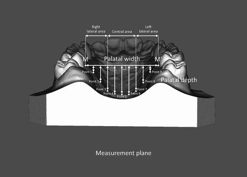 Figure 3. Assessment of palatal morphology on the plaster model of the maxilla.