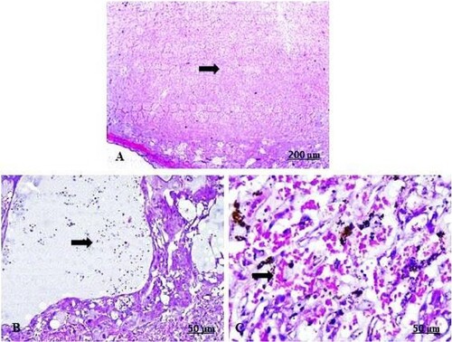 Figure 6. (A–C) Light photomicrograph of sections from maternal placenta of control (A) and GAE received group (B, C) stained with H & E.: light photomicrograph of (A) shows normal vascular and avascular villi of the placenta. Photomicrograph of (B) shows severe hylanized and dilated villi filled with edematous fluid. Photomicrograph of (C) shows severe congestion of the blood capillaries.