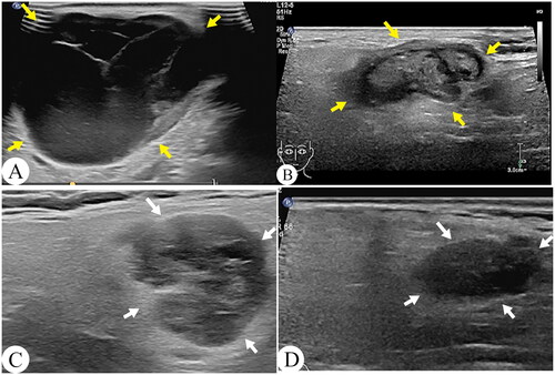 Figure 4. Ultrasound images of patients before and after TA. A, B a 91-year-old man with a cystic Warthin tumor in the right parotid gland. Figure A showed the ultrasound image before ablation, with a tumor size of 6.3 × 5.2 cm, Figure B showed the image 6 months after ablation, with the tumor size reduced to 2.7 × 1.5 cm. C, D a 51-year-old man with a Warthin tumor in the left parotid gland. Figure C showed the ultrasound image before ablation with a tumor size of 2.6 × 1.7 cm, Figure D showed the image 6 months after ablation, with the tumor size reduced to 1.9 × 1.1 cm. Yellow and white arrows indicated the edge of tumors.