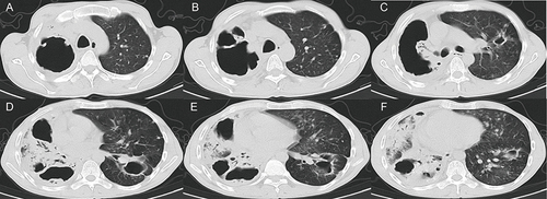 Figure 3 The CT images of DR-TB patients. (A–F) A 43-year-old man had a history of repeated cough and sputum for more than 5 years. He experienced aggravation with hemoptysis for over 1 year, followed by recurrence and worsening of his condition for 6 days. The sputum smear is positive. Both lungs show numerous cavities, nodules, and calcified shadows of various sizes. The cavity has an irregular shape, uneven wall thickness, and visible local wall nodules. (A–C) Depicts the largest cavity. (D–F) Some lung tissue is consolidated with air bronchial shadow present in it. (A–F) Cavity shadows with varying sizes of arrows and uneven wall thickness in both lungs (red arrow), and wall nodules (blue arrow) can be seen in some of the cavities. (D–F) There is patchy consolidation in the right lung (yellow arrow).