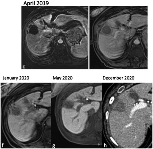 Figure 8. Evolution of the ablation zone from the previous case, showing no evidence of recurrence 10 months after the ablation.