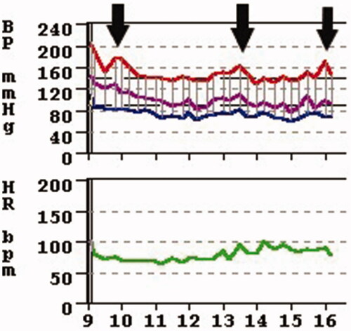 Figure 4. The author’s own observation on an 8-h ABPM (Ambulatory Blood Pressure Monitoring) revealing an acute blood pressure elevation at 09:30, 13:30 and 16:00, the exact time when the patient indicated that she smoked a cigarettes, Also note, that incidentally a severe white coat effect is also observable as the initial blood systolic pressure is over 200 mmHg yet the sustained blood pressure is around 150 mmHg.