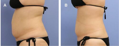 Figure 8 (A) Baseline; (B) 1 month after 2 abdominal treatments. It visibly shows the reduction on lower abdomen and circumference reduction above navel of −10.7 cm.