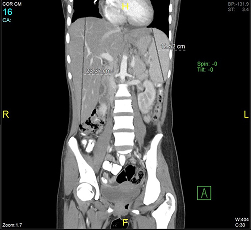 Figure 5 The hepatosplenomegaly condition can be seen on CT scan image.