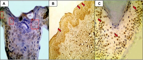 Figure 1 (A) Patchy mild cytoplasmic expression of gal-9 (red boxes) in control epidermis (Immunoperoxidase, 400 ×); (B) Diffuse moderately nucleo-cytoplasmic expression (red arrows) of gal-9 is in epidermal keratinocytes in AD skin section (Immunoperoxidase, 40 ×); (C) Mild nuclear expression (red arrows) of gal-9 in the epidermal keratinocytes of AD skin section (Immunoperoxidase, 400 ×).