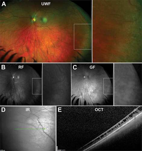 Figure 5. 32 year old Caucasian female with microcystoid degeneration. (A) UWF imaging demonstrates microcystoid degeneration in the infero - temporal peripheral retina and (B) red –free and (C) green-free images highlight the increased choroidal reflex due to the cysts. (D) On infra-red imaging, microcystoid degeneration can appear as a hazy area. (E) Peripheral OCT through the structure highlights separation of the inner retinal layers typical in reticular microcystoid degeneration. Abbreviations as in Figure 3.