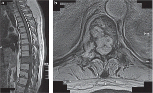 Figure 1. Osteoblastic metastatic bone tumor developing in the spinal canal at the tenth thoracic vertebra: (a), sagittal view; (b), horizontal view.