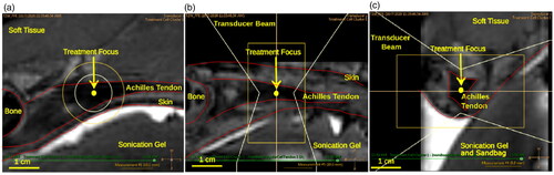 Figure 3. T2-weighted MRI image of the Achilles tendon used in the treatment planning of MRgFUS sonication. Treatment position is verified in (a) sagittal, (b) axial, and (c) coronal views.