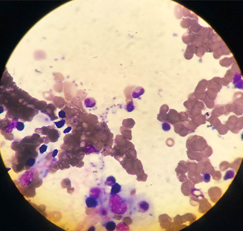 Figure 2 Bone marrow aspirate showed Leishman-Donovan bodies and hemophagocytosis. Wright’s staining, ×100 oil immersion lens.