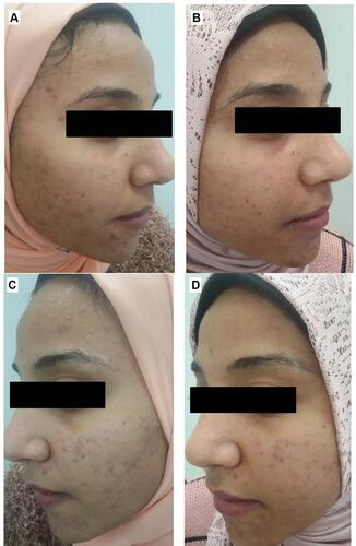 Figure 13 Right side of face before (A) and after topical tretinoin (B). Left side of the face before (C) and after ethosomal RP hydrogel (D).