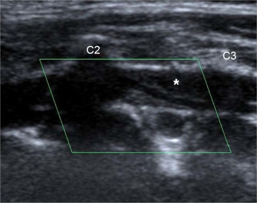 Figure 1 Duplex ultrasound (B-mode) shows narrowing of left intervertebral VA. The asterisk indicates the false lumen caused by intramural hematoma.