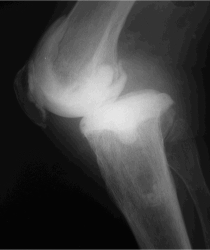 Figure 5. Subluxation of a spacer.