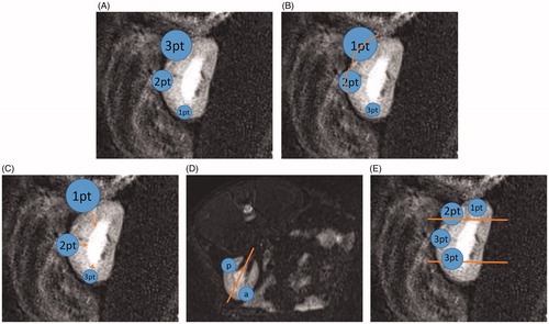 Figure 6. Explanation of the nephrometry scoring system. (A) R (radius): tumors ≤4 cm are assigned 1 point, those >4 but <7 cm are assigned 2 points, and those >7 cm are assigned 3 points. (B) E (exophytic/endophytic): tumors that are 50% or more exophytic are assigned 1 point, tumors that are less than 50% exophytic are assigned 2 points, those that are completely inside the renal cortex are assigned 3 points. (C) N (nearness): Tumors that are ≥7 mm far from the collecting system or sinus are assigned 1 point, tumors that are >4 but <7 mm far from the collecting system or sinus are assigned 2 points, and those <7 mm far are assigned 3 points. (D) A (anterior): If the tumor is located on the ventral surface, the suffix “a” is assigned; if it is located on the dorsal surface, the suffix “p” is assigned; and if it is not possible to clearly identify the location of tumor, the suffix “x” is assigned. (E) L (location): If tumors are entirely located above or below the polar lines, then 1 point is assigned, tumors that exceed the polar lines but within <50% are assigned 2 points, and those that exceed >50% or entirely between the upper polar line and lower polar line are assigned 3 points.