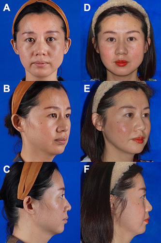 Figure 13 Preoperative (A–C) and 6 months postoperative (D–F) digital photographs of female patient from Figure 9 who underwent jowl and medial cheek fat repositioning. Major improvement is seen in the mid-cheek grooves, midcheek volume, nasolabial folds, and jowl area.