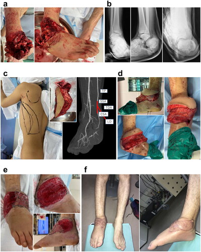 Figure 1. Patient 1. (A) Upon arrival at the emergency room, the blood circulation in the right foot was poor. (B) Multiple fractures and dislocations were observed after performing radiographic examination. (C) The recipient artery was interposed with T portion and the flow was sutured through anastomosis to the TP artery. (D) On day 9, free LD flap was performed. Abbreviation: (E) After the third tangential excision (4 weeks after LD flap). (F) Appearance at 3.5 months after injury. TP: tibialis posterior artery; SSA: subscapular artery; CSA: circumflex scapular artery; TDA: thoracodorsal artery; LD: latissimus dorsi.