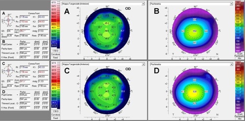Figure 5 Baseline (A, B) and one-month follow-up (C, D) Scheimpflug corneal maps (anterior tangential and thickness maps, respectively) for a representative case (A02) in the study group. One month after hypertonic treatment, central corneal thickness decreased by 11 μm.