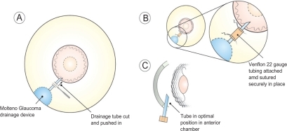 Figure 3 Salient features of the tube extension surgery.
