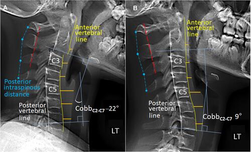 Figure 1 Comparison of cervical alignment on sagittal radiographs in neutral position. (A) At the initial assessment, several of the vertebrae were wedge-shaped, allowing for slippage of the C2 on C3 and C3 on C4.The global curvature of the C2-C7 spine using Cobb angle (four blue lines) was –22°, a reversed cervical lordosis. Intraspinous distance (dashed blue lines) was within 1.5 times the distance of the level either above or below and the spinous processes of C1 to C3 (dashed red line) was aligned within 1 mm of each other, suggestive an integrity of the interspinous ligaments. (B) 12-months later, the vertebral configuration became roughly rectangular. Restored cervical alignment and cervical lordosis yielded simultaneous remission of neurological symptoms. With reference to the initial image, there was 31° (–22° vs 9°) correction of the cervical lordosis. Reduced width of the prevertebral soft-tissue thickening (Orange lines) could signify a relief of previously swollen soft-tissue.