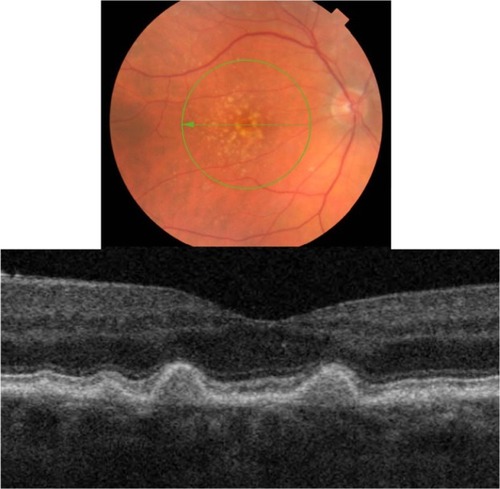 Figure 9 Fundus photograph (top) showing hard cuticular drusen in the right eye of a patient with ARMD; the B-scan line on the fundus photograph has the same width as the B-scan SD-OCT image (bottom) which demonstrates the appearance of hard cuticular drusen.