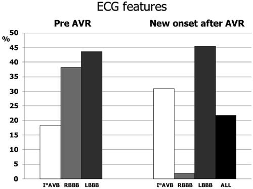 Figure 1. ECG worst prognostic factor for pacemaker implantation according to survey respondents. (A) before aortic valve replacement (AVR); (B) new onset after AVR (From reference [Citation16]).