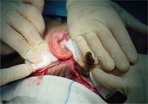 Figure 3 Excess glue is squeezed out from the dissected area through the skin incision and eliminated.