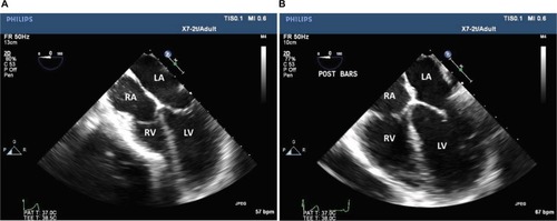 Figure 2 Transesophageal echocardiographic images show preoperative effect (A) of pectus excavatum with compression on the right ventricle due to the inward sternal deformity and relief of the compression following surgical repair (B).