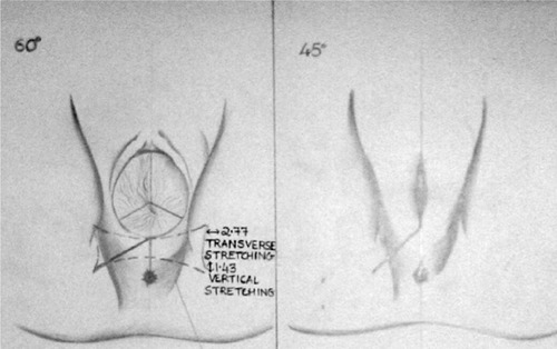 Figure 2 60 degree episiotomy at crowning resulting in a 45 degree post-delivery angle.